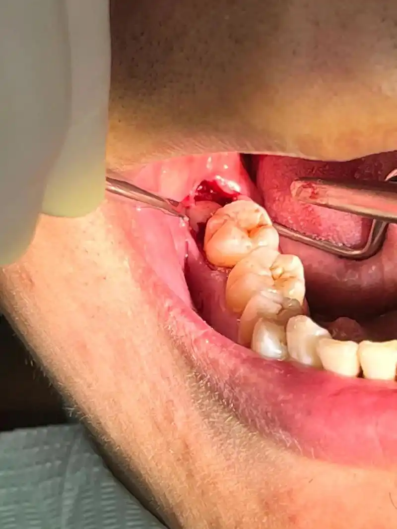 再见,歪智齿朋友#拔智齿 #智齿拔除过程 - 抖音