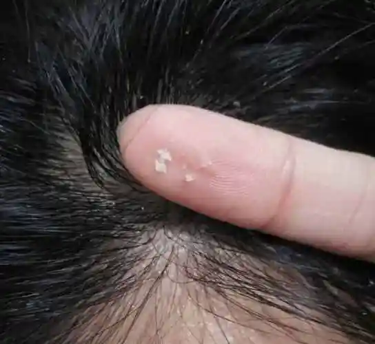 头顶有这4个怪象,多半是螨虫正在堵塞毛囊,两招螨虫被清光