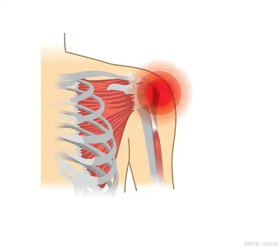 肩袖损伤有什么症状表现?可以使用针灸治疗吗?生活管理也很重要