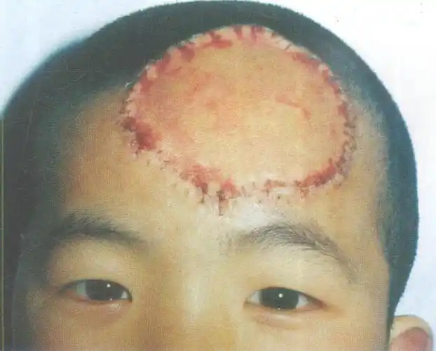 1周后植皮成活-深度创面修复整形手术-医学