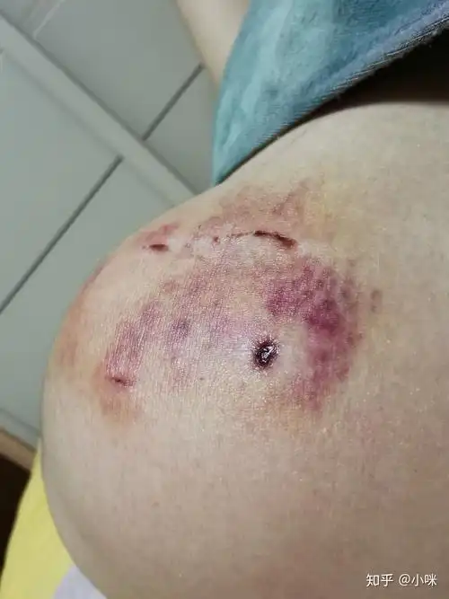 被加菲咬了记录伤口愈合过程哈