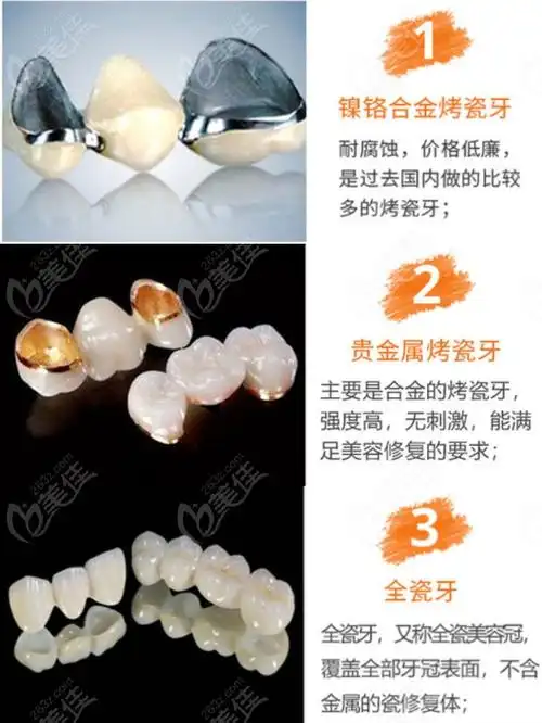 镍铬合金烤瓷牙贵金属烤瓷牙全瓷牙区别