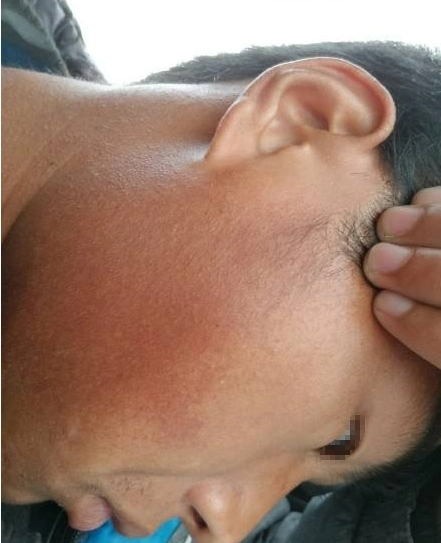 想不到你居然是这种皮肤—毛周角化症