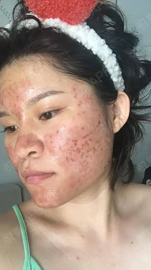 co2点阵激光术后20天_去疤痕痘印术后20天_皮肤美容术后20天_青柠乐呀