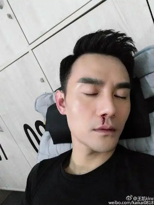 王凯晒流鼻血照片 自我调侃:我又没看啥