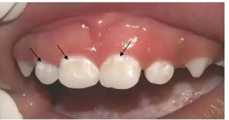 宝宝牙齿有点脱矿和白斑怎么办?