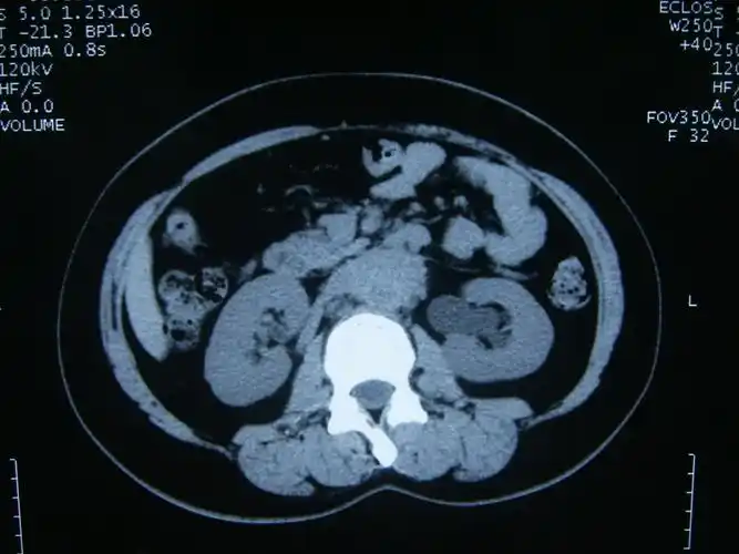 看图讨论一例肾积水病人