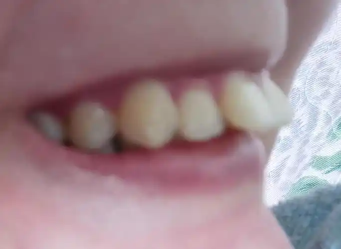 大门牙前突,拜托大家帮忙看一看我这个牙齿是深覆合还是深覆盖呀?