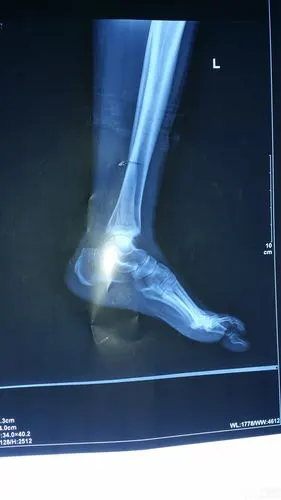 这例内外踝加肝功能损伤到底做还是不需要做?