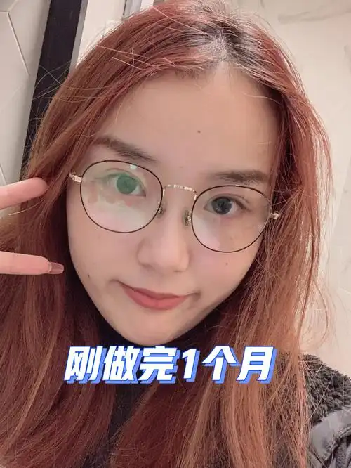 朋友都说我之前单眼皮好看