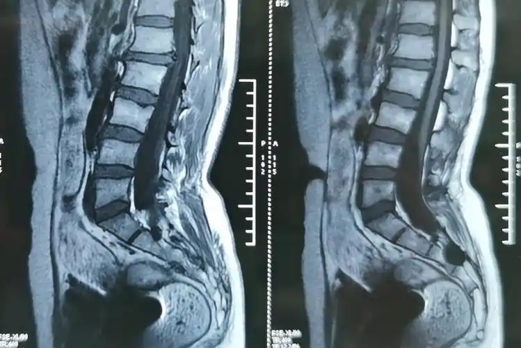 骶管囊肿真的是小病吗