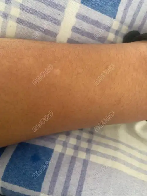 请各位看一下胳膊上的小白点是白白吗?因为母亲有,实在担心!
