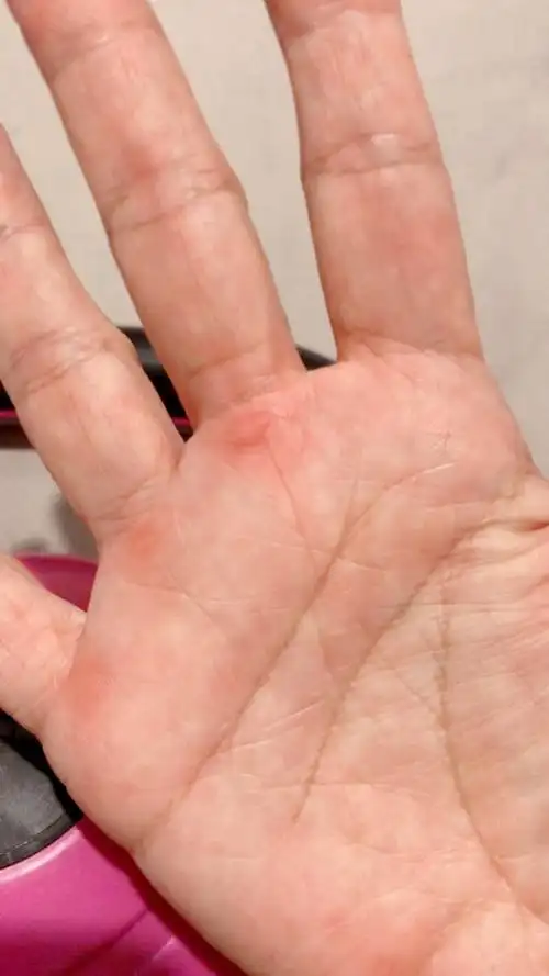 昨晚睡前,开心的甩了一会儿壶铃,然后左右手都磨出了水泡,我把水泡