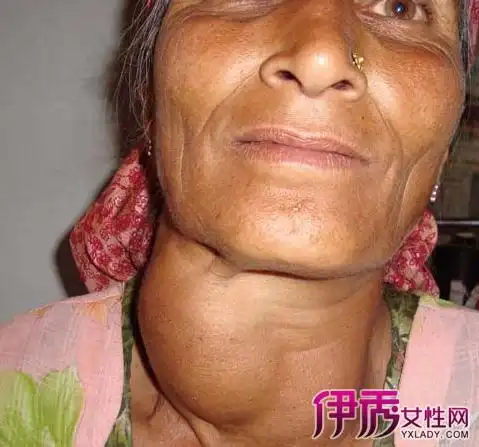 【图】大脖子病症状图片 如何进行中医治疗和护理