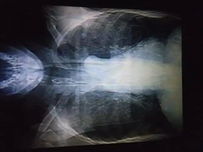 急性支气管炎一例