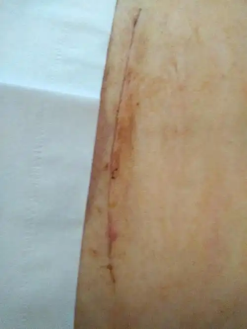 今天剖宫产滴9天去医院看伤口恢复情况一切完美