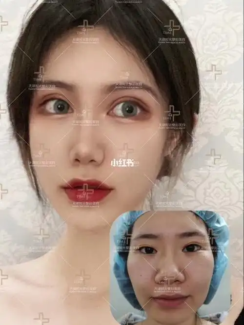 眼综合时尚芭比眼术后6个月