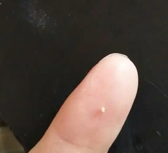 脸上偶尔起痘挤破了有白色的是什么原因