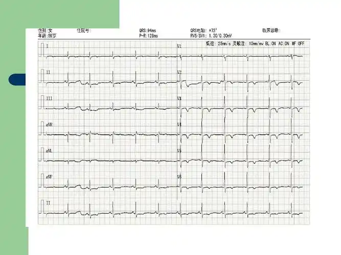 冠状动脉供血不足的典型心电图表现