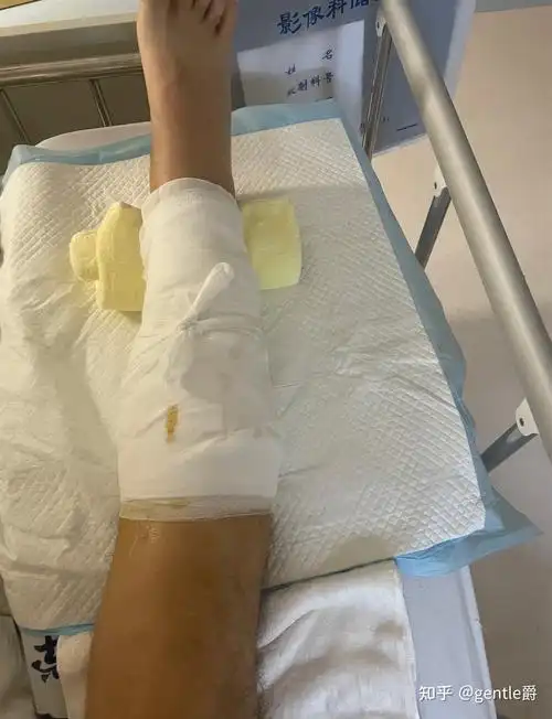 请问小腿胫腓骨骨折多久可以愈合