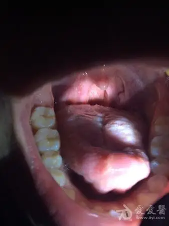 向各位专家求助鉴定是否口腔尖锐湿疣