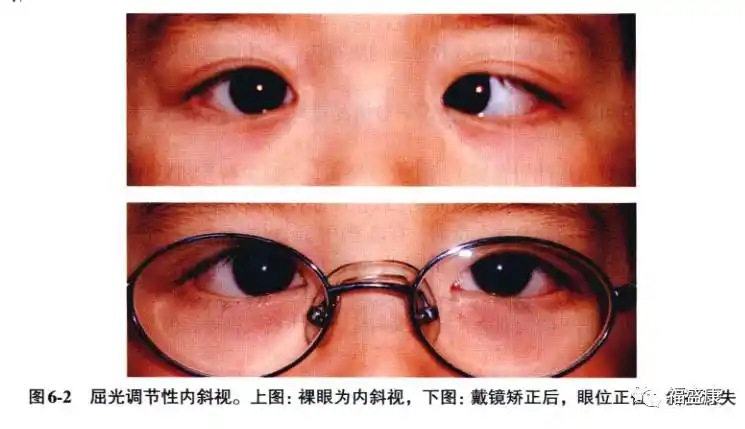 专业共同性内斜视的概述