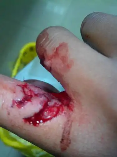 我的手指在工作时不小心被台钻绞破了皮,缝了10多针,饮食上,不能吃
