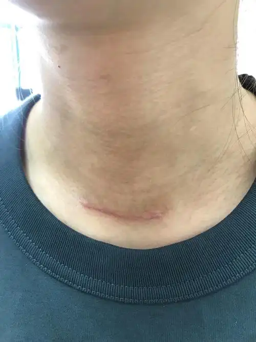 麻烦忽视我疤痕上方的脏脏,擦起来真的痛 麻木关于药量:上周满一个月