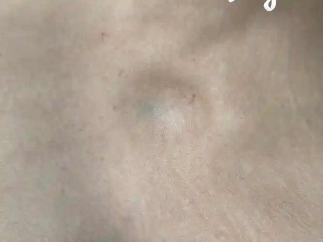 皮脂腺囊肿微创治疗,不开刀不缝合,1个月后神奇愈合了,没有留疤