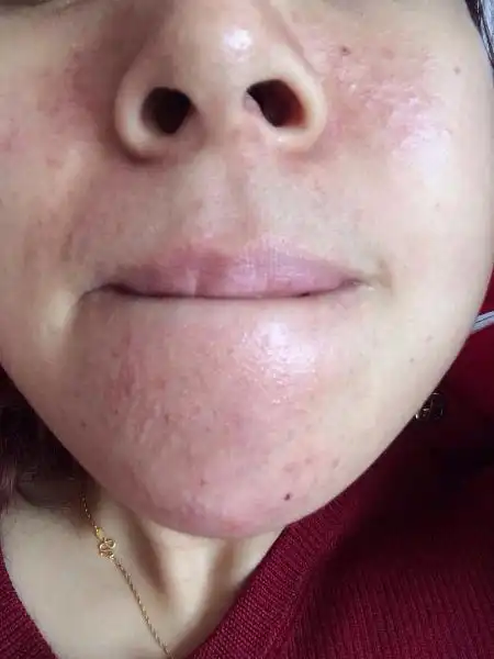 脂溢性皮炎是一种常见的皮肤疾病,由于其症状会影响到皮肤的美观,所以