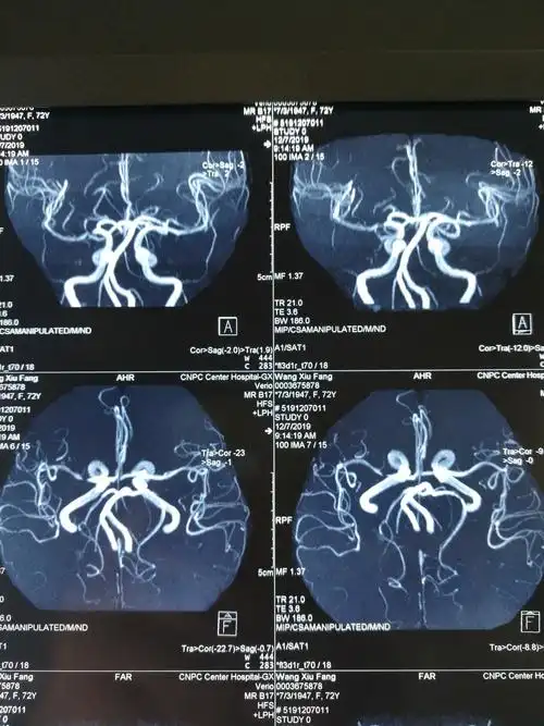 30床,王秀芳,女,72岁,636142,右侧大脑中动脉m1段狭窄