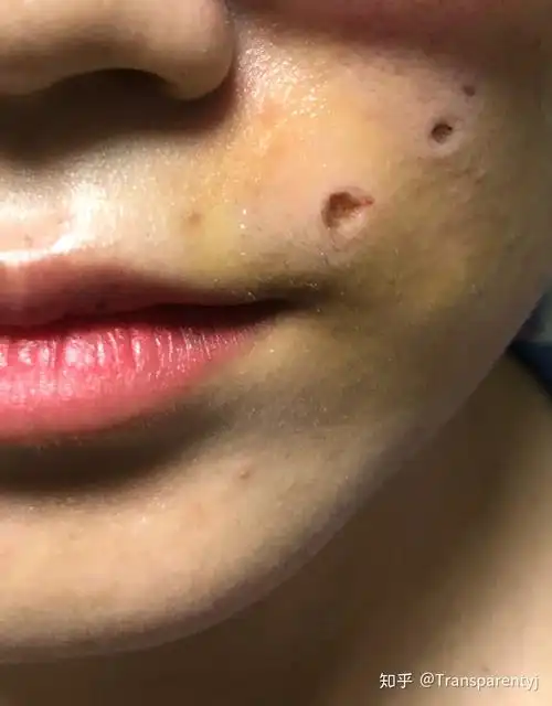 激光点痣祛痣祛斑是什么体验