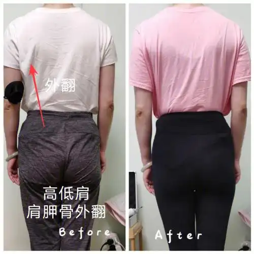 蜜芮日式整骨高低肩矫正术