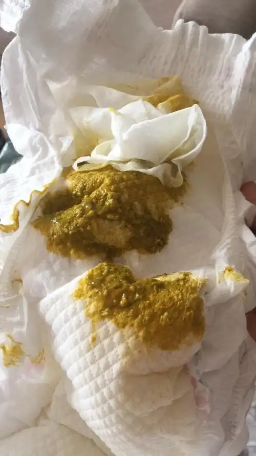 4月宝宝这种大便正常吗?拉的时候有点像果冻黏膜一样