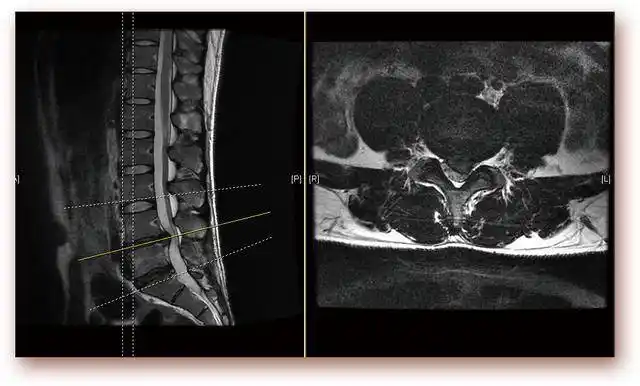 腰椎核磁显示腰间盘突出(l4-5)腰椎ct显示腰椎间盘突出(l4-5)保守治疗