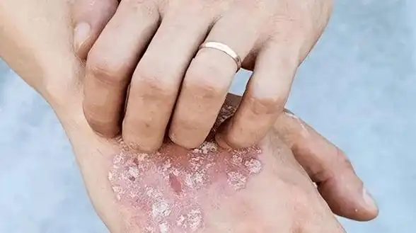 牛皮癣为什么会痒