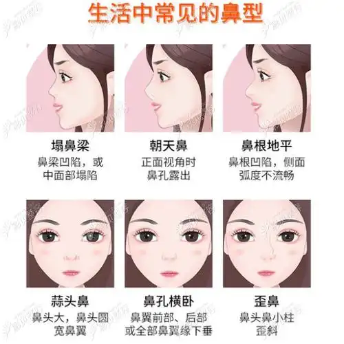 常见的鼻类型