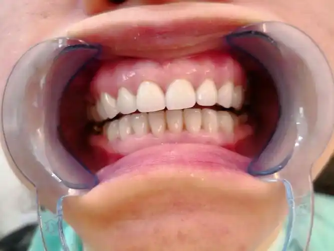 各种牙齿疑难杂症修复案例