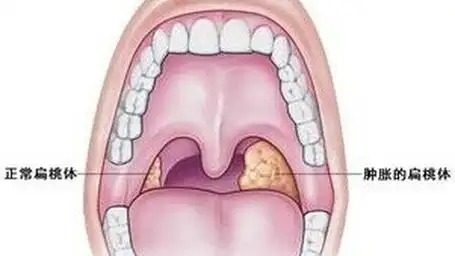 小儿扁桃体炎怎么推拿