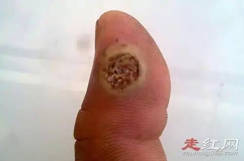 莲蓬乳和空手指视频是啥为何物什么病怎么形成的