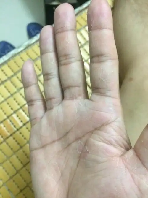 手掌脱皮是怎么回事?汗疱疹