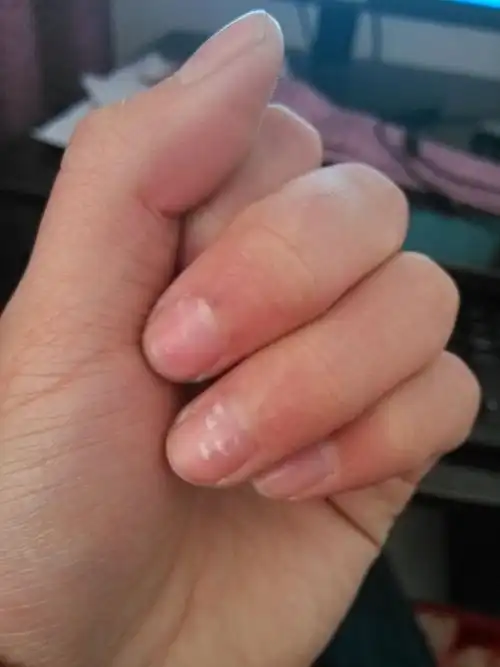 手指甲上有白点是怎么回事? 是不是缺少什么维生素呢?