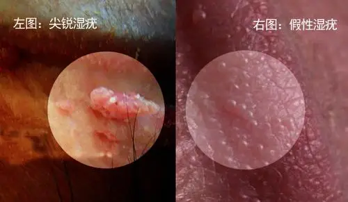 假性湿疣vs尖锐湿疣_尖锐湿疣_尖锐湿疣症状表现 - 好大夫在线