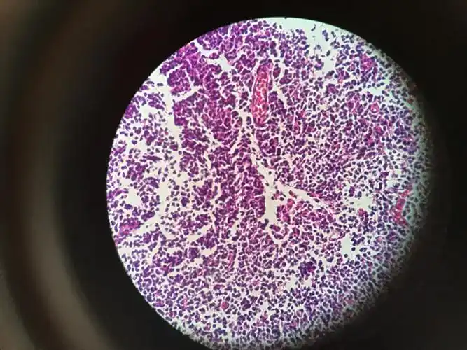 胆囊炎伴淋巴组织增生