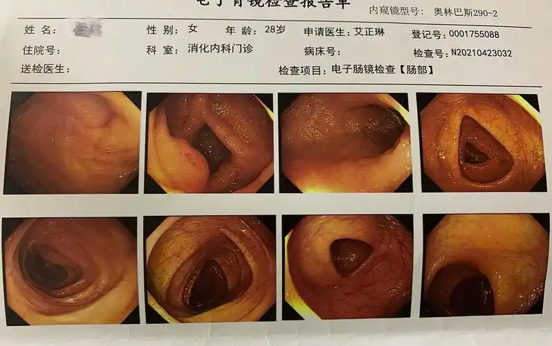 迟来的《肠镜实录》