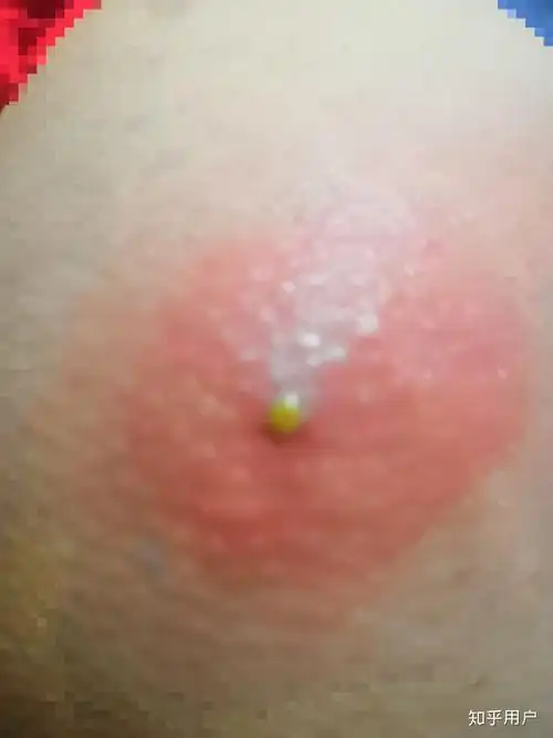 请问屁股上长了火疖子该怎么办?