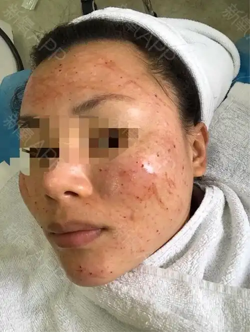 氧气y7vr6水光针第0天美丽日记