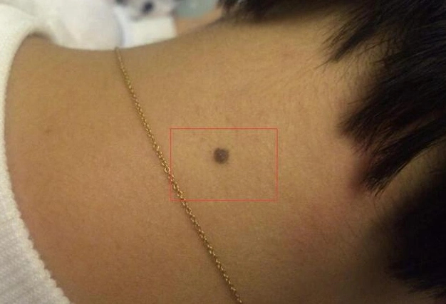 痣相图解什么是苦情痣有苦情痣会有这样的命运