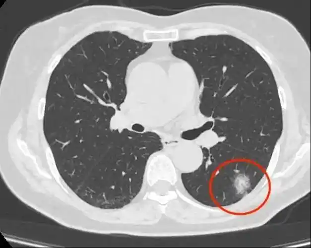 体检疑似肺癌?别急,ct引导下肺穿刺活检术为您明确诊断!
