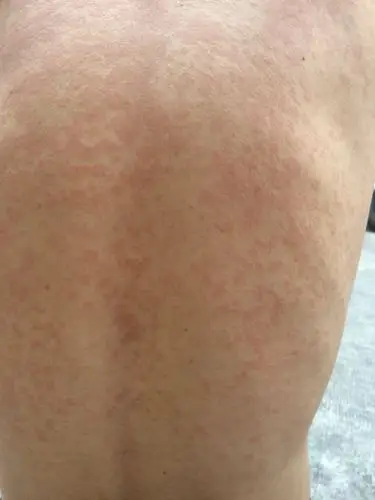 身上长了红色疹子,但是不痛不痒,请问这是什么回事?